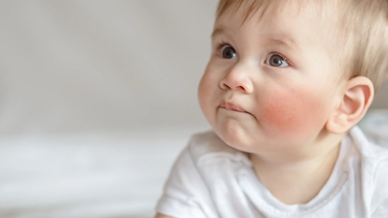 ایجاد لکه های قرمز ناشی از اگزما روی صورت کودک