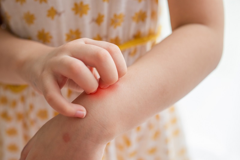 حساسیت پوستی در کودکان