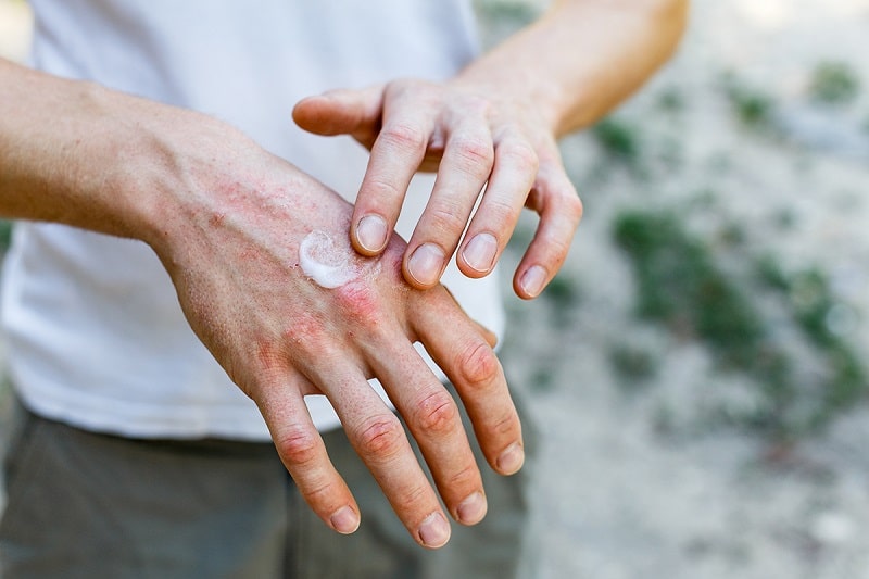 دست کسی که دچار خشکی پوست در زمستان شده است