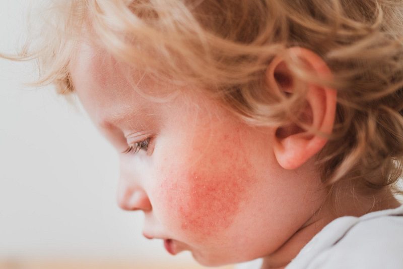 علائم اگزما روی گونه کودک