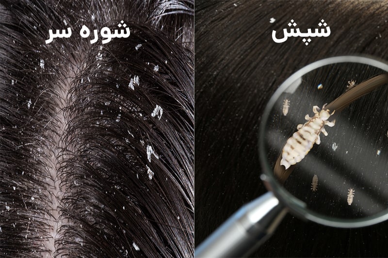 شپش و شوره سر